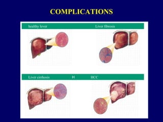 Liver cirrhosis H HCC
healthy lever Liver fibrosis
COMPLICATIONS
 