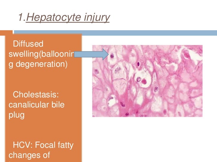 Hepatitis correlation2