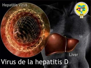 Virus de la hepatitis D
 