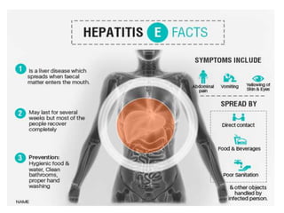 HEPATITIS E | PPT