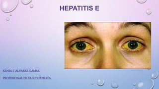 HEPATITIS E
KENIA I. ALVAREZ GAMEZ
PROFESIONAL EN SALUD PUBLICA.
 