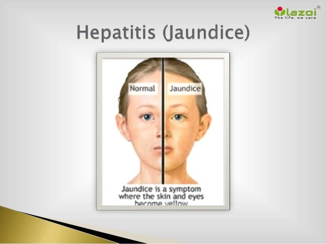 Hepatitis Jaundice Hepatitis Jaundice
