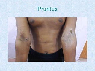 Pruritus
 