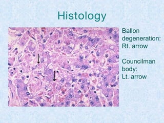 Histology
Ballon
degeneration:
Rt. arrow
Councilman
body:
Lt. arrow
 