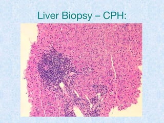 Liver Biopsy – CPH:
 