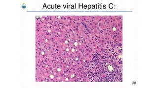 Acute and chronic Hepatitis MBBS second year .pptx