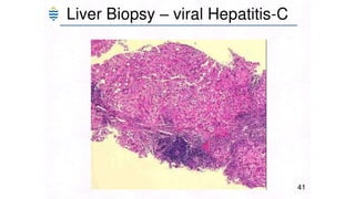 Acute and chronic Hepatitis MBBS second year .pptx