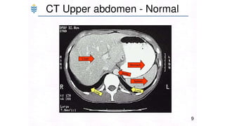 Acute and chronic Hepatitis MBBS second year .pptx
