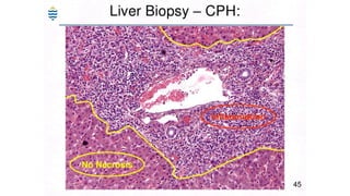 Acute and chronic Hepatitis MBBS second year .pptx
