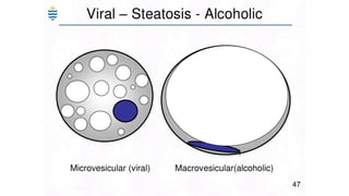 Acute and chronic Hepatitis MBBS second year .pptx