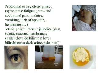 10
Prodromal or Preicteric phase :
(symptoms: fatigue, joint- and
abdominal pain, malaise,
vomiting, lack of appetite,
hepatomegaly)
Icteric phase: Icterus: jaundice (skin,
sclera, mucous membranes,
cause: elevated bilirubin level,
bilirubinuria: dark urine, pale stool)
 