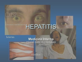 HEPATITIS Medicina Interna CESAR GARCIA CASALLAS 2011 