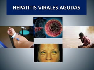 HEPATITIS VIRALES AGUDAS
 