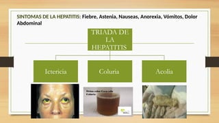 TRIADA DE
LA
HEPATITIS
Ictericia Coluria Acolia
SINTOMAS DE LA HEPATITIS: Fiebre, Astenia, Nauseas, Anorexia, Vómitos, Dolor
Abdominal
 