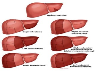 Picture of Surgical resections
 