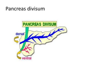 Pancreas divisum
 