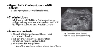 Hyperplastic Cholecystoses and GB
polyps:
oFocal/polypoid GB wall thickening
Cholesterolosis:
oMultiple small (1-10 mm) nonshadowing
polyps arising from non-dependent wall with
echogenic speckles and lobular contour
Adenomyomatosis:
oGB wall thickening focal/diffuse, most
common in fundus
oIn body there is annular constriction
producing hourglass shaped GB
oRisk factor for malignancy:
• Age >60 yr, coexistence of gall stones, size > 10mm
Fig. Gallbladder polyps (arrows).
Note the lack of acoustic shadowing.
 