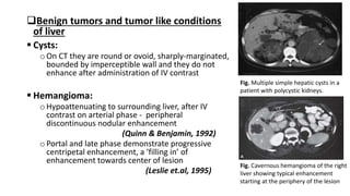 Benign tumors and tumor like conditions
of liver
 Cysts:
oOn CT they are round or ovoid, sharply-marginated,
bounded by imperceptible wall and they do not
enhance after administration of IV contrast
 Hemangioma:
oHypoattenuating to surrounding liver, after IV
contrast on arterial phase - peripheral
discontinuous nodular enhancement
(Quinn & Benjamin, 1992)
oPortal and late phase demonstrate progressive
centripetal enhancement, a ‘filling in’ of
enhancement towards center of lesion
(Leslie et.al, 1995)
Fig. Multiple simple hepatic cysts in a
patient with polycystic kidneys.
Fig. Cavernous hemangioma of the right
liver showing typical enhancement
starting at the periphery of the lesion
 