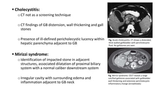  Cholecystitis:
oCT not as a screening technique
oCT findings of GB distension, wall thickening and gall
stones
oPresence of ill-defined pericholecystic lucency within
hepatic parenchyma adjacent to GB
 Mirizzi syndrome:
oIdentification of impacted stone in adjacent
structures, associated dilatation of proximal biliary
system with a normal caliber downstream system
oIrregular cavity with surrounding edema and
inflammation adjacent to GB neck
Fig. Acute cholecystitis. CT shows a distended,
thick-walled gallbladder with pericholecystic
fluid. No gallstones are seen.
Fig. Mirrizi syndrome. CECT reveals a large
calcified gallstone associated with gallbladder
wall thickening and extensive pericholecystic
inflammatory change (arrowheads).
 
