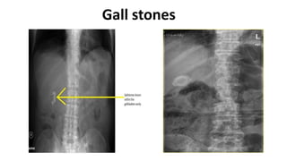 Gall stones
 