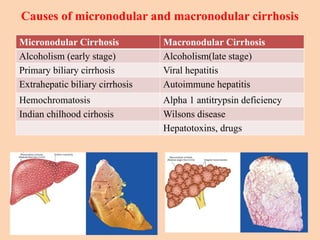 Causes of micronodular and macronodular cirrhosis
Micronodular Cirrhosis Macronodular Cirrhosis
Alcoholism (early stage) Alcoholism(late stage)
Primary biliary cirrhosis Viral hepatitis
Extrahepatic biliary cirrhosis Autoimmune hepatitis
Hemochromatosis Alpha 1 antitrypsin deficiency
Indian chilhood cirhosis Wilsons disease
Hepatotoxins, drugs
 
