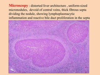 Microscopy : distorted liver architecture , uniform-sized
micronodules, devoid of central veins, thick fibrous septa
dividing the nodule, showing lymphoplasmacytic
inflammation and reactive bile duct proliferation in the septa
 