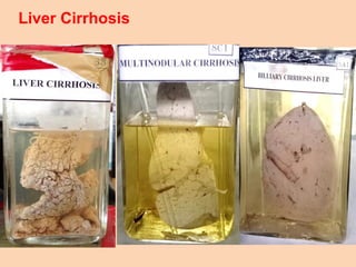 Liver Cirrhosis
 