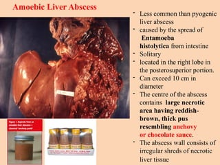 Amoebic Liver Abscess
- Less common than pyogenic
liver abscess
- caused by the spread of
Entamoeba
histolytica from intestine
- Solitary
- located in the right lobe in
the posterosuperior portion.
- Can exceed 10 cm in
diameter
- The centre of the abscess
contains large necrotic
area having reddish-
brown, thick pus
resembling anchovy
or chocolate sauce.
- The abscess wall consists of
irregular shreds of necrotic
liver tissue
 
