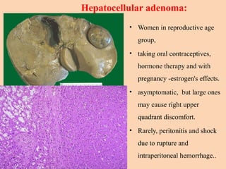 Hepatocellular adenoma:
• Women in reproductive age
group,
• taking oral contraceptives,
hormone therapy and with
pregnancy -estrogen's effects.
• asymptomatic, but large ones
may cause right upper
quadrant discomfort.
• Rarely, peritonitis and shock
due to rupture and
intraperitoneal hemorrhage..
 