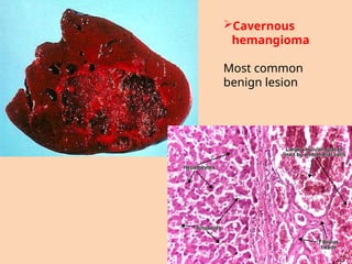 Cavernous
hemangioma
Most common
benign lesion
 