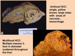 Unifocal HCC:
single, yellow
brown, large mass
with areas of
necrosis ,
hemorrhage
Multifocal HCC:
Multiple masses 3-
5cm in diameter
scattered throughout
the liver
 