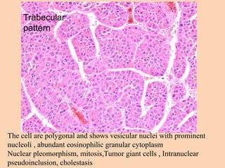 Trabecular
pattern
The cell are polygonal and shows vesicular nuclei with prominent
nucleoli , abundant eosinophilic granular cytoplasm
Nuclear pleomorphism, mitosis,Tumor giant cells , Intranuclear
pseudoinclusion, cholestasis
 