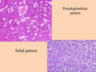 Pseudoglandular
pattern
Solid pattern
 