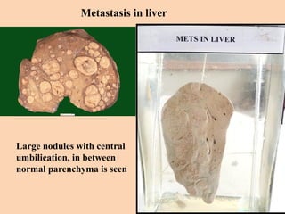 Metastasis in liver
Large nodules with central
umbilication, in between
normal parenchyma is seen
 