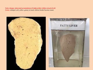 Fatty change: abnormal accumulation of triglycerides within cytosol of cell
Gross: enlarged ,soft, yellow ,greasy to touch, inferior border become round,
 