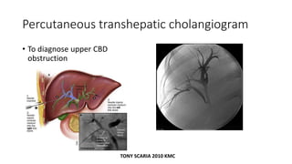 Percutaneous transhepatic cholangiogram
• To diagnose upper CBD
obstruction
TONY SCARIA 2010 KMC
 