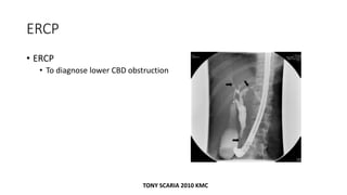 ERCP
• ERCP
• To diagnose lower CBD obstruction
TONY SCARIA 2010 KMC
 