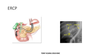 ERCP
TONY SCARIA 2010 KMC
 