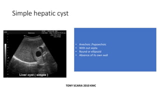 Simple hepatic cyst
• Anechoic /hypoechoic
• With out septa
• Round or ellipsoid
• Absence of its own wall
TONY SCARIA 2010 KMC
 