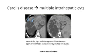 Carolis disease  multiple intrahepatic cyts
TONY SCARIA 2010 KMC
 