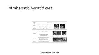 Intrahepatic hydatid cyst
TONY SCARIA 2010 KMC
 