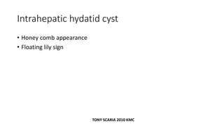 Intrahepatic hydatid cyst
• Honey comb appearance
• Floating lily sign
TONY SCARIA 2010 KMC
 