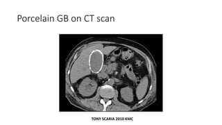 Porcelain GB on CT scan
TONY SCARIA 2010 KMC
 