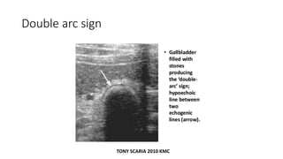 Double arc sign
TONY SCARIA 2010 KMC
 