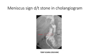 Meniscus sign d/t stone in cholangiogram
TONY SCARIA 2010 KMC
 