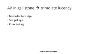 Air in gall stone  triradiate lucency
• Mercedez benz sign
• Sea gull sign
• Crow feet sign
TONY SCARIA 2010 KMC
 
