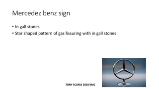 Mercedez benz sign
• In gall stones
• Star shaped pattern of gas fissuring with in gall stones
TONY SCARIA 2010 KMC
 