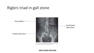 Riglers triad in gall stone
Small bowel
obstruction
Ectopic Gall stone
Pneumobilia
TONY SCARIA 2010 KMC
 