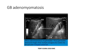GB adenomyomatosis
TONY SCARIA 2010 KMC
 