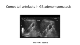 Comet tail artefacts in GB adenomyomatosis
TONY SCARIA 2010 KMC
 